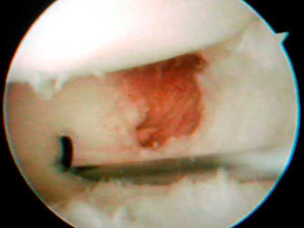Lesión-del-fibrocartílago-triangular-Artroscopia-de-muñeca