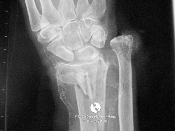 1 Fractura del Radio FEDR ARTICULAR