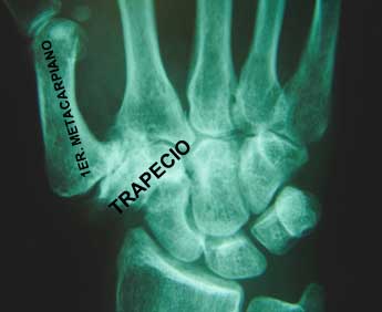 Diagnóstico de la rizartrosis o artrosis del dedo pulgar de la mano