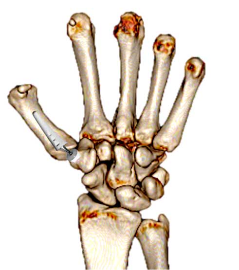 Prótesis trapeciometacarpiana. (Tratamiento 3).