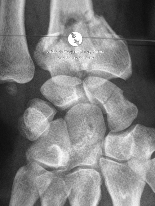 Fractura del Radio. Fractura del Escafoides.