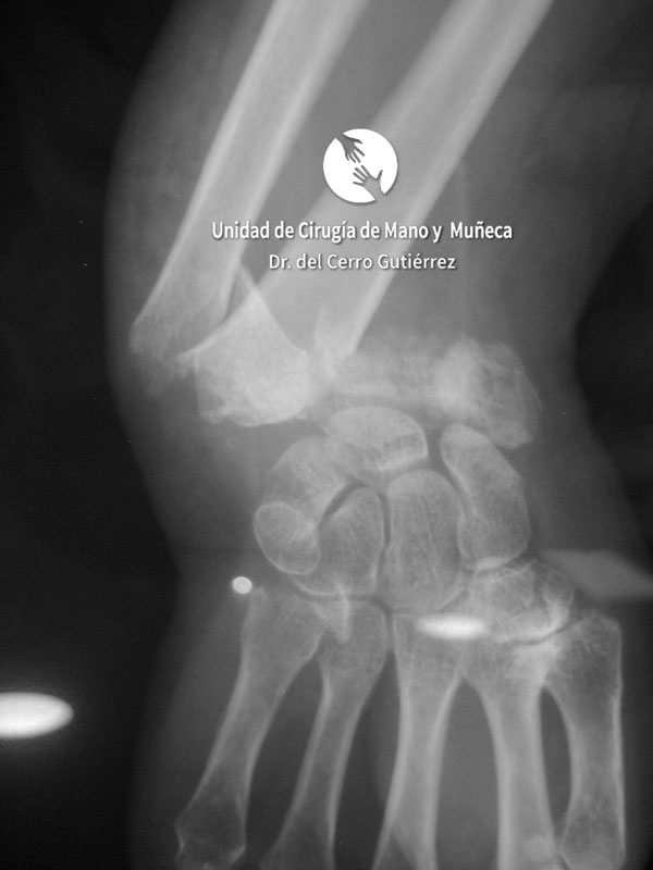 Fractura del Radio. Conminuta y Articular.