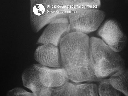 Fractura del Escafoides Pseudoartrosis del tercio medio