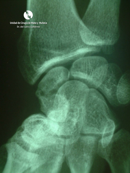 Fractura del Escafoides Pseudoartrosis escafoides injerto con tornillo