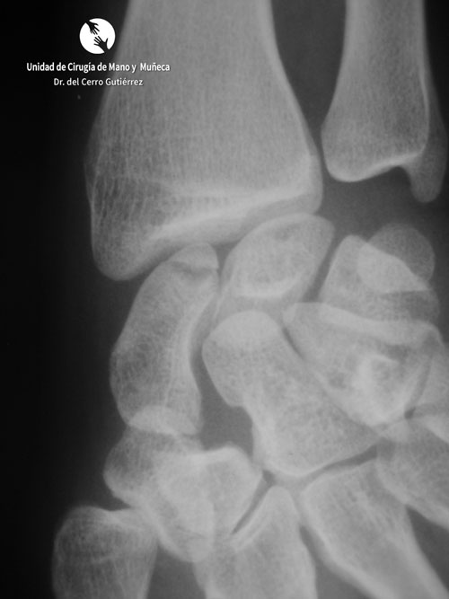 Fractura del Escafoides. Fractura del Polo Proximal