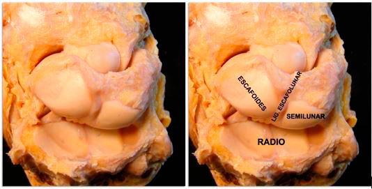 disección del carpo y descripción de sus partes incluído ligamento escafolunar