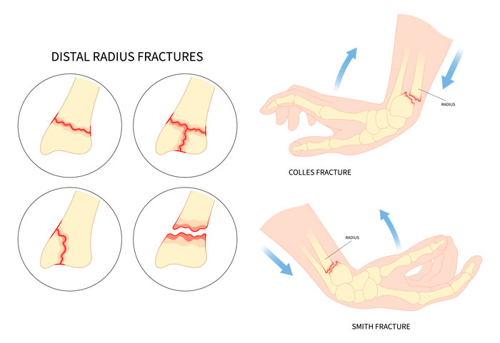 fractura del radio distal